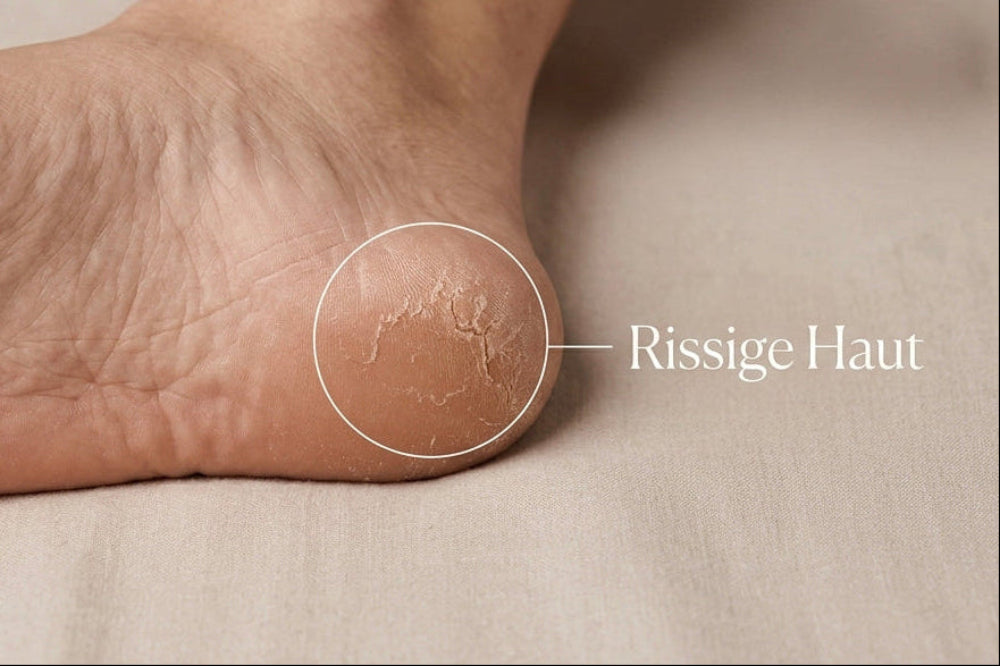 Rissige Fersen entstehen oft dann, wenn die Haut an den Füßen zu trocken, rau und stark beansprucht ist.